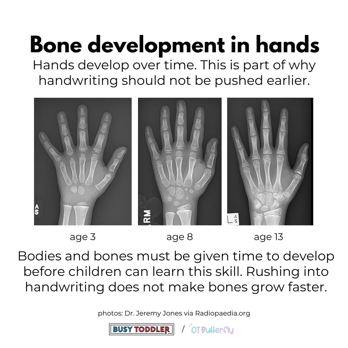 Bone development in hand: image shows an x-ray of three children's hands at ages 3, 8, and 13 to explain bone growth and its impact on handwriting.